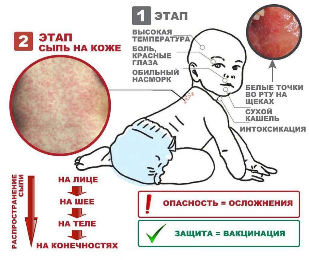 Кор болезнь. Каорь.