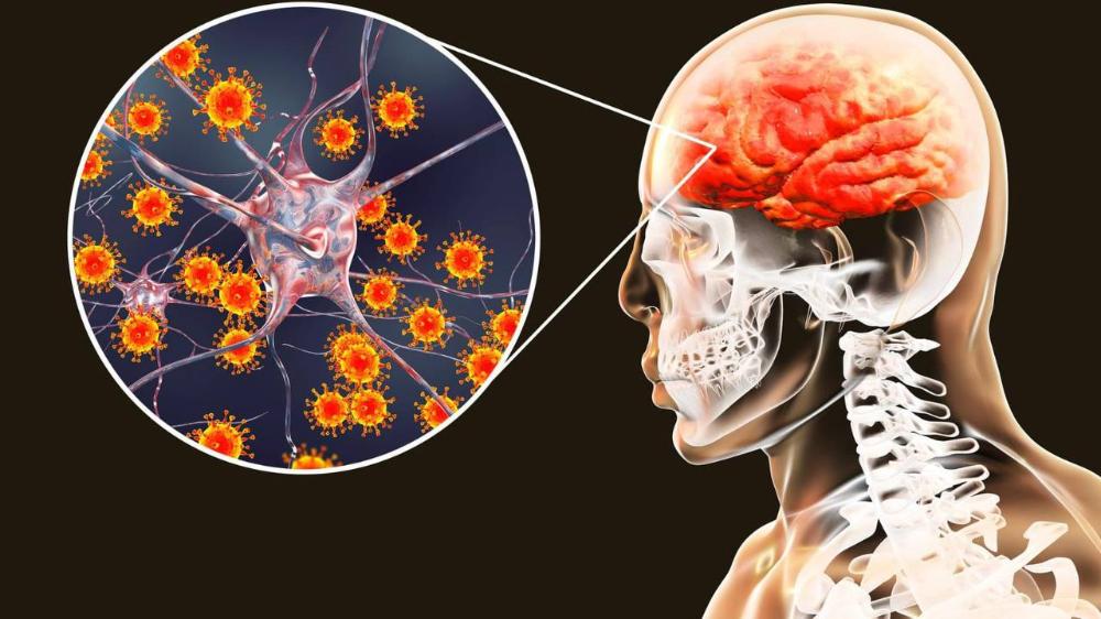 Менингит - это тяжелое воспалительное поражение оболочек головного и спинного мозга