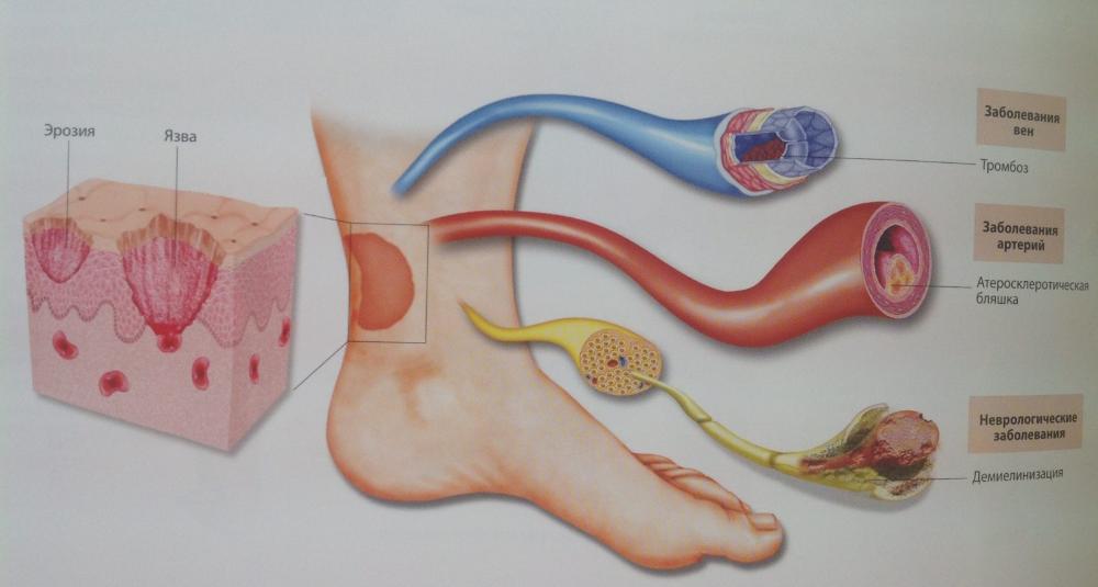 Что нужно знать о трофических язвах?