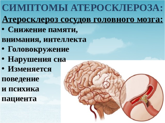 Врожденные заболевания артерий. Основные симптомы атеросклероза артерий головного мозга:. Основной симптом при атеросклерозе артерий головного мозга. Атеросклероз сосудов головного МОЗ. Клинические проявления атеросклероза сосудов головного мозга.